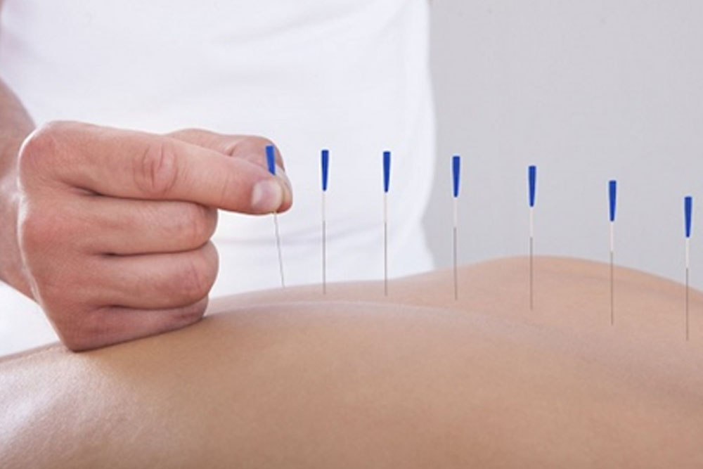 Acupuncture Therapy Treatment