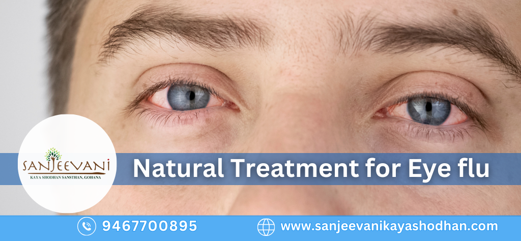 Natural Treatment for Eye flu