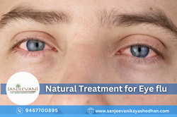 Natural Treatment for Eye flu